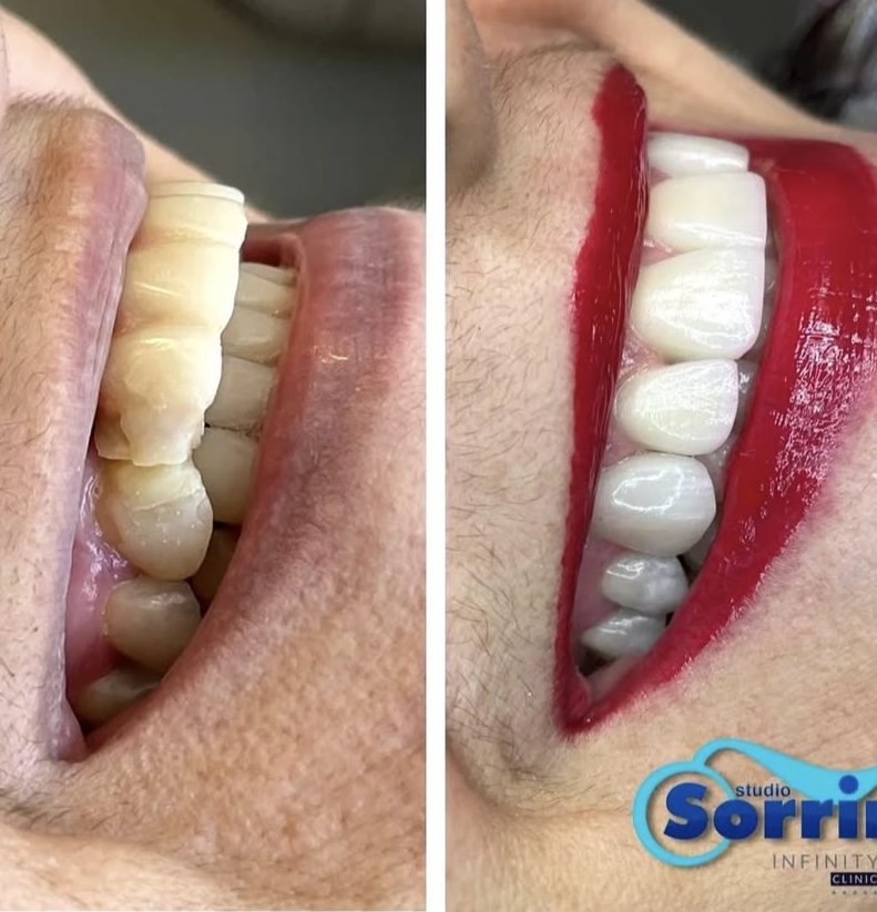 Antes e depois de pacientes com implantes dentários em Recife