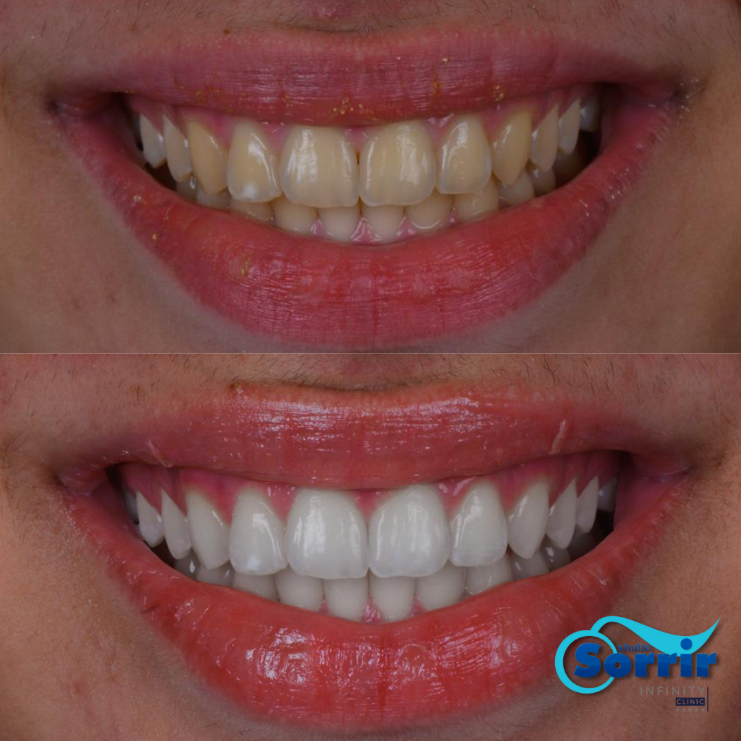Resultado do clareamento dental em paciente Studio Sorrir