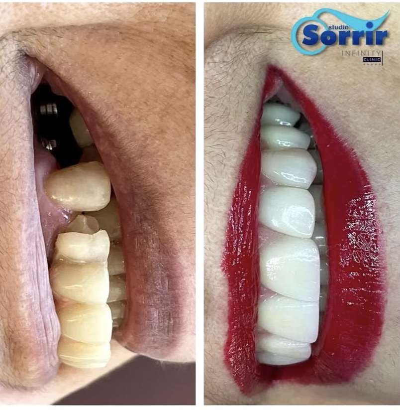 Antes e depois de pacientes com implantes dentários em Recife
