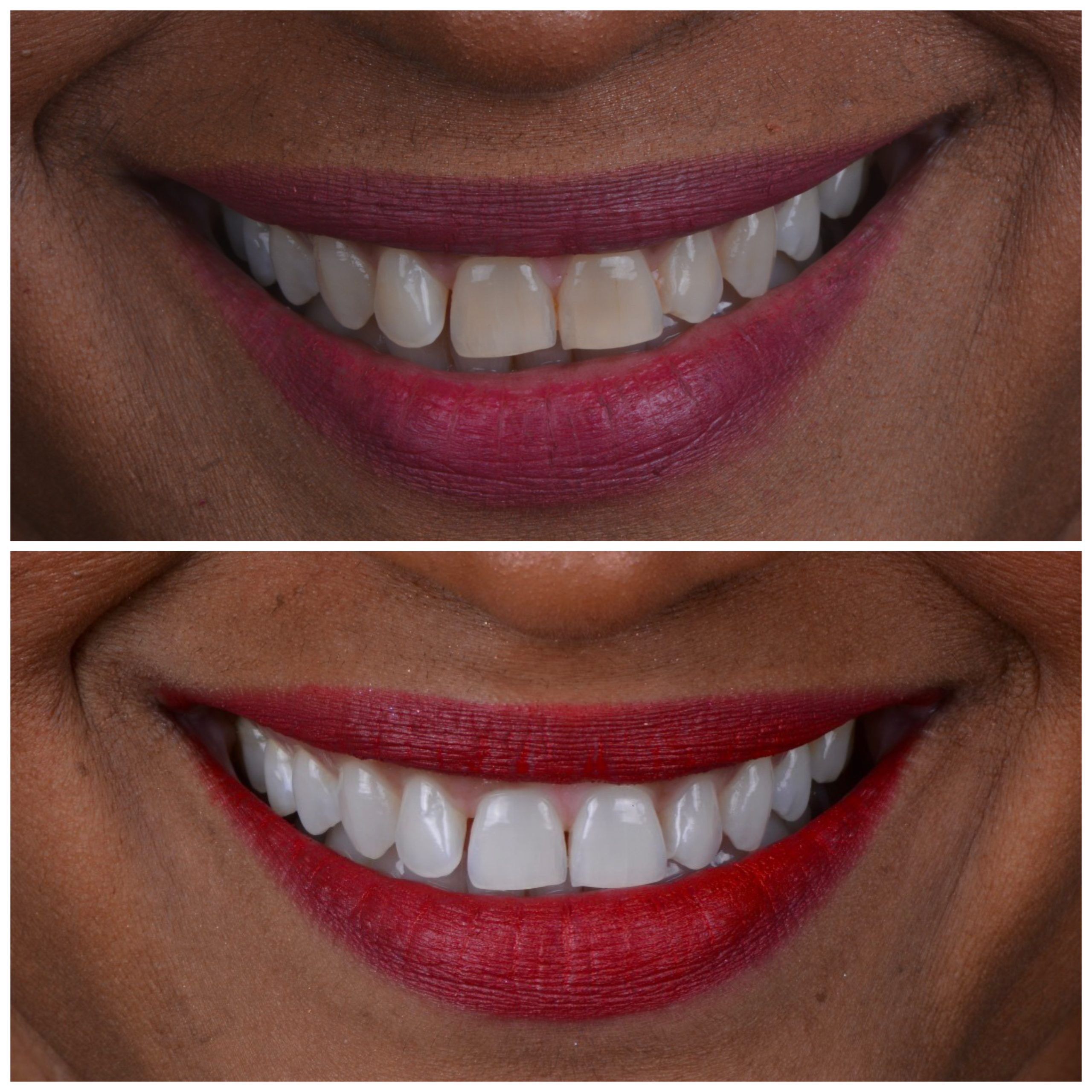 Resultado do clareamento dental em paciente Studio Sorrir