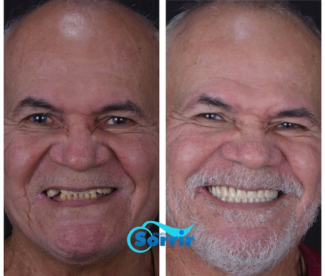 antes e depois da prótese protocolo em Recife