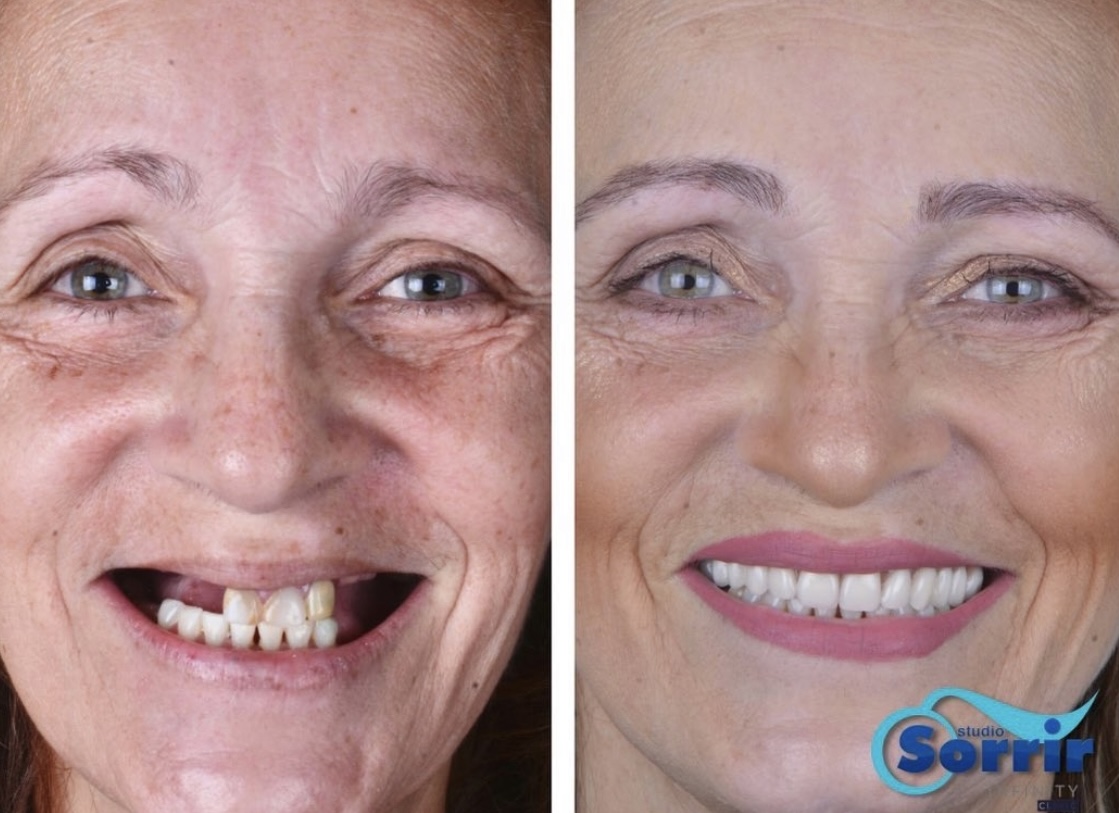 antes e depois da prótese protocolo em Recife