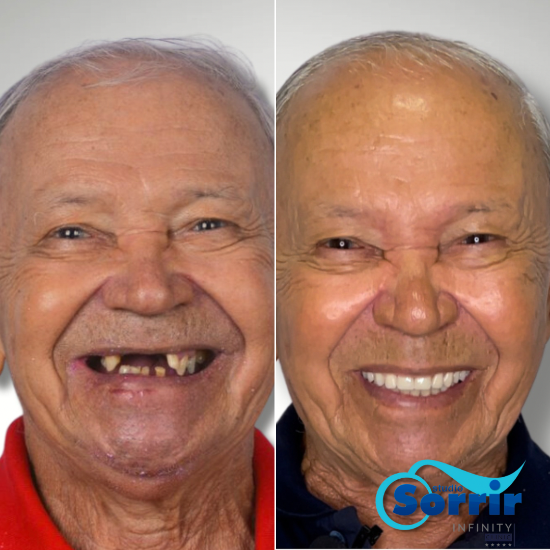 antes e depois da prótese protocolo em Recife