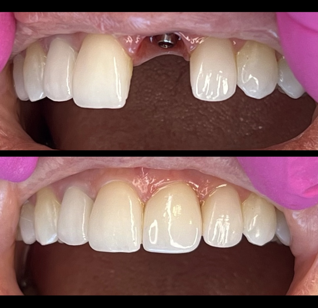 Antes e depois de pacientes com implantes dentários em Recife