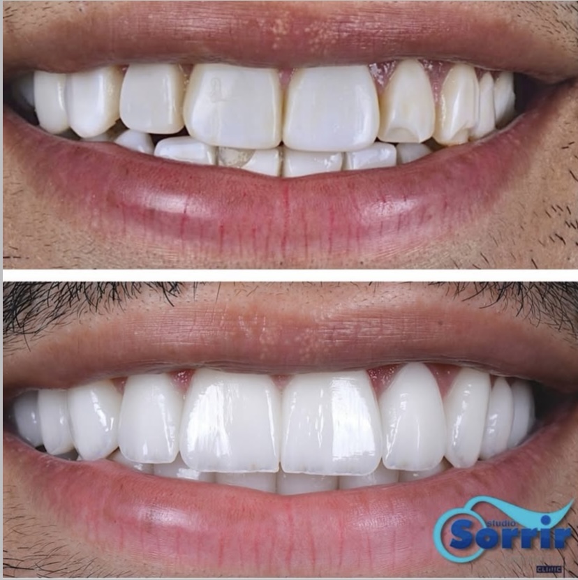 Resultado antes e depois do tratamento com lentes de contato dental