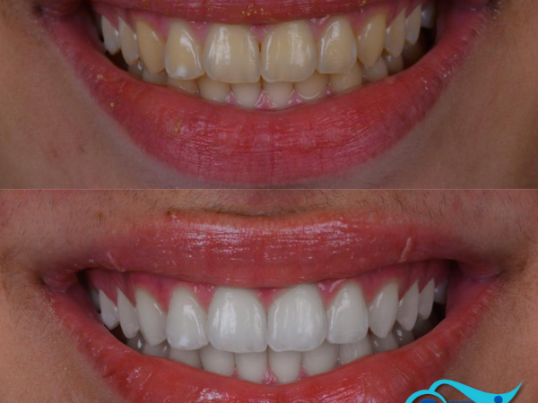 Resultado do clareamento dental realizado na Studio Sorrir em Recife