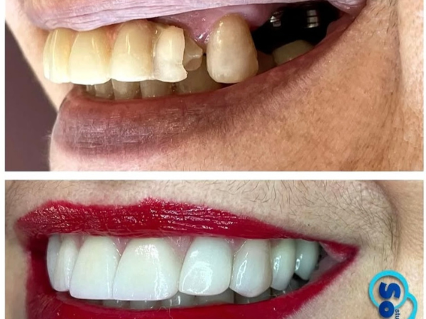 Reabilitação com implantes dentários na Studio Sorrir em Recife