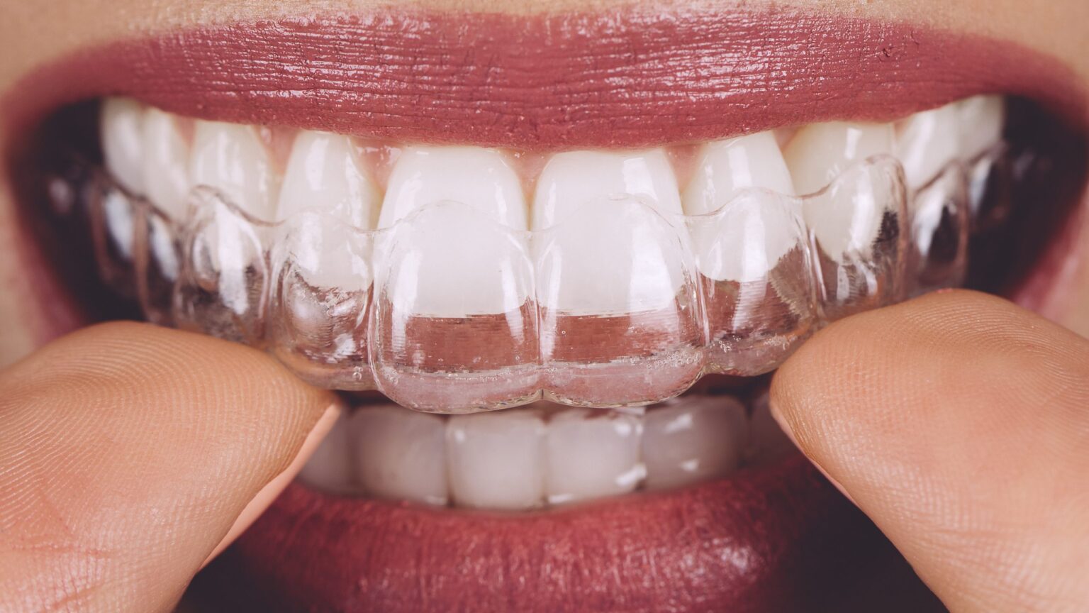 Paciente colocando alinhador Invisalign nos dentes