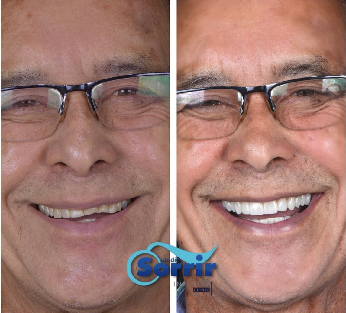 Resultado antes e depois do tratamento com lentes de contato dental