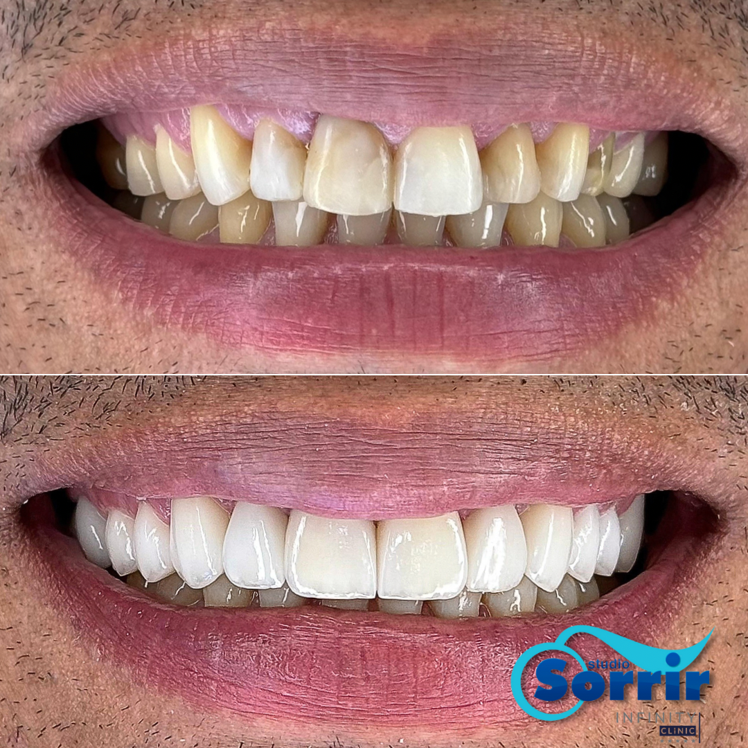 Resultado antes e depois do tratamento com lentes de contato dental