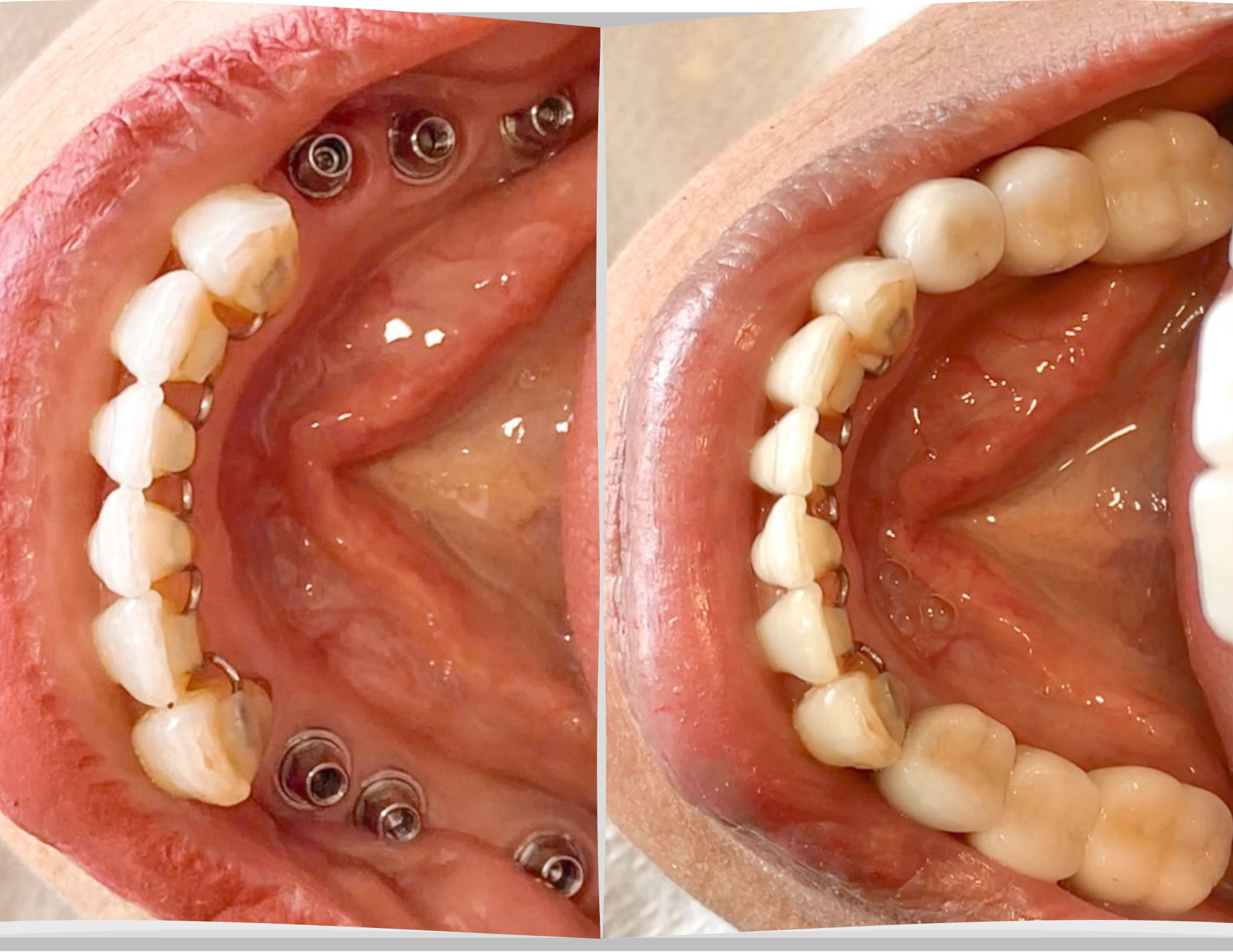Antes e depois de pacientes com implantes dentários em Recife
