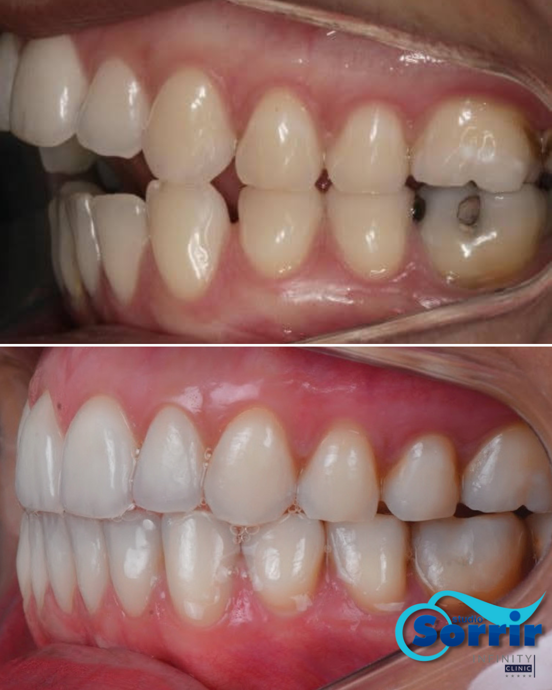 Antes e depois do tratamento com Invisalign na Studio Sorrir em Recife