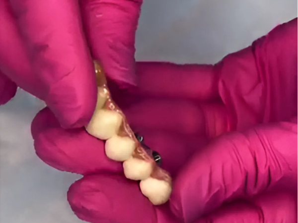 Detalhe técnico de implantes dentários em preparo na Studio Sorrir em Recife