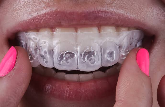 Aplicação de clareamento dental com moldeira na Studio Sorrir em Recife